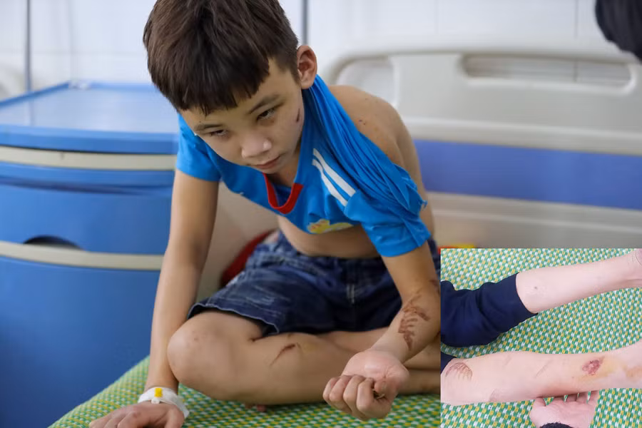 Hình ảnh em Duy với những vết thương chằng chịt trên cơ thể khi được giải cứu khỏi quán bánh xèo.