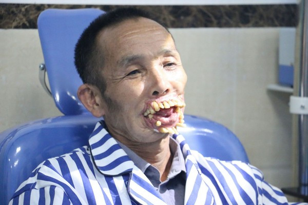 tái tạo gương mặt sau 54 năm bị chó sói tấn công