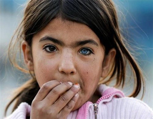 Nhiều người có hai mắt với hai màu khác biệt. Ảnh minh họa: Reddit.com.