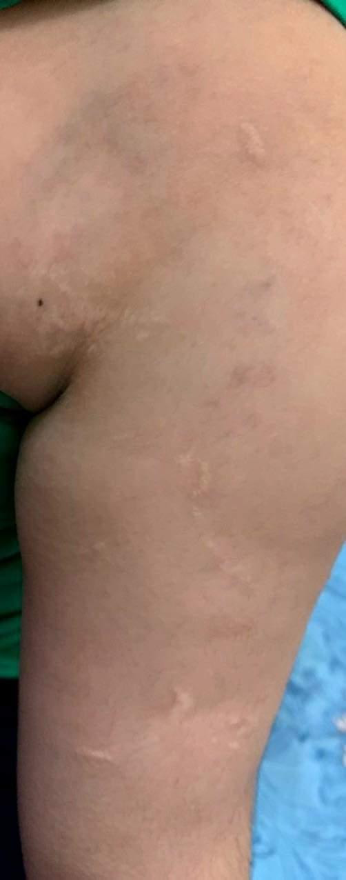 Nhiều vết thương khác trên người cháu T. khai do bị "thầy" Q. đánh. Nhiều vết thương khác trên người cháu T. khai do bị "thầy" Q. đánh.