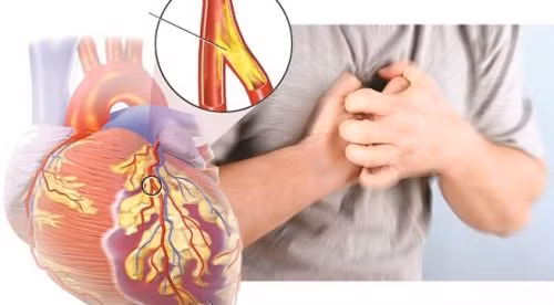 Hút thuốc lá - Nguy cơ mắc bệnh tim mạch rất cao