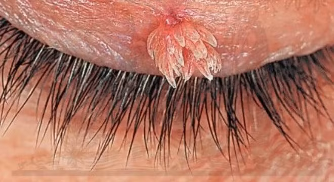 “Dính” sùi mào gà ở mắt vì rửa chung khăn mặt