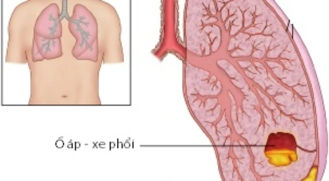 Cảnh báo áp-xe phổi ở trẻ tái xuất