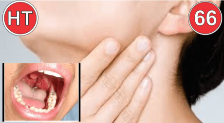 Cách chữa hóc xương cá hay nuốt phải vật cứng - Ảnh 1 Cach chua hoc xuong ca hay nuot phai vat cung - Anh 1