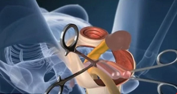 Video đặc tả quá trình phẫu thuật chuyển giới tư nam sang nữ
