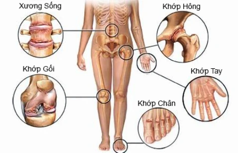 Các vị trí dễ bị thoái hóa khớp. Ảnh: camnanglamdep. 