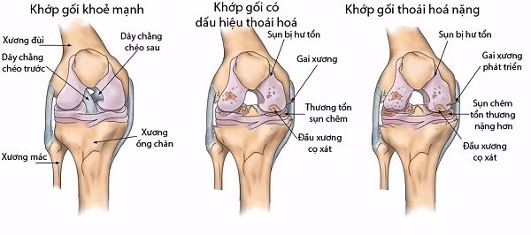 Sự khác biệt giữa khớp gối khỏe mạnh và khi bị thoái hóa
