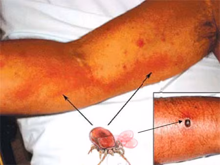 Nhung dieu can biet ve virus gay benh sot mo nguy hiem - Anh 2