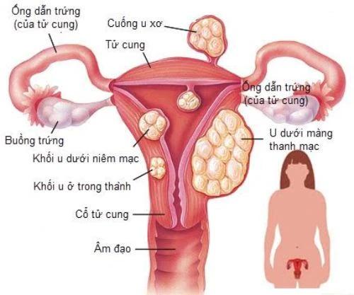 Các vị trí thường xuất hiệnu xơ tử cung. Ảnh:sanphukhoa.