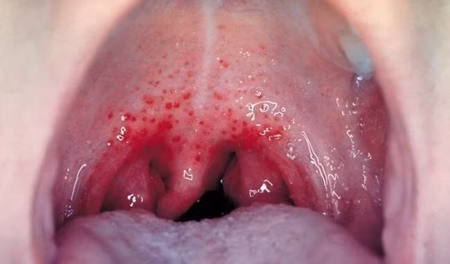 Những chấm nhỏ màu đỏ trên vòm miệng của người bị viêm họng liên cầu khuẩn