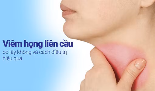 Viêm họng liên cầu rất dễ lây lan