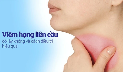 Viêm họng liên cầu rất dễ lây lan