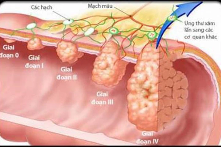 Dấu hiệu sớm nhận biết ung thư đại trực tràng