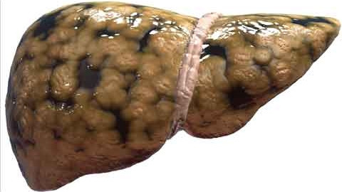 gan nhiễm mỡ, bệnh gan nhiễm mỡ, phòng ngừa gan nhiễm mỡ gan nhiễm mỡ, bệnh gan nhiễm mỡ, phòng ngừa gan nhiễm mỡ