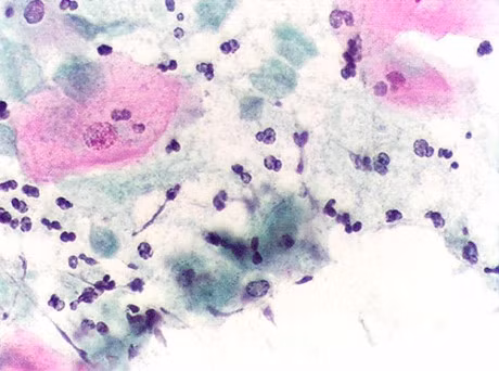 Nho nuoc bot vao coc nuoc moi sang de phat hien benh truoc khi qua muon - Anh 3