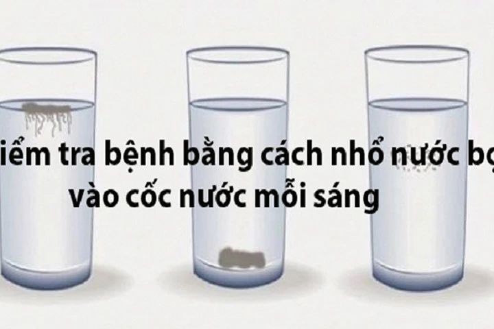 Nhổ nước bọt vào cốc nước mỗi sáng để phát hiện bệnh trước khi quá muộn