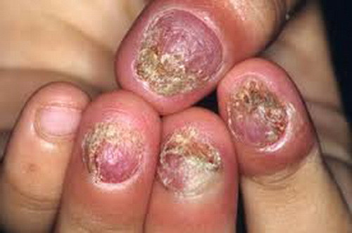 Nấm móng do nấm Candida. Nấm móng do nấm Candida.