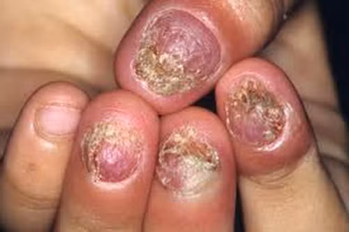 Nấm móng do nấm Candida.