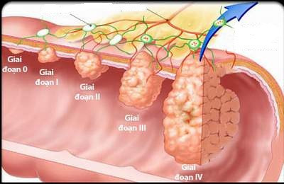 Bất ngờ với những nguyên nhân gây ung thư đại trực tràng - Ảnh 1 Bat ngo voi nhung nguyen nhan gay ung thu dai truc trang - Anh 1
