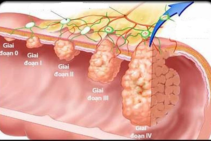 Bất ngờ với những nguyên nhân gây ung thư đại trực tràng