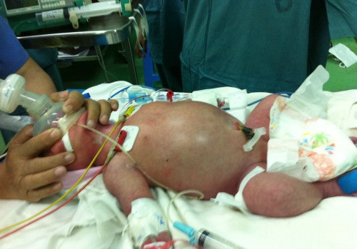 Em bé chào đời 36 giờ bị vỡ dạ dày hiếm gặp ảnh 1 em-be-chao-doi-36-gio-bi-vo-da-day-hiem-gap-1