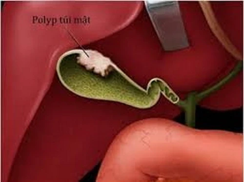 Khi bị polyp túi mật cần được theo dõi bằng hình thức khám bệnh định kỳ.