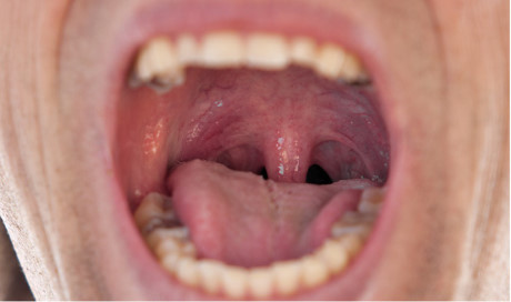 Ngủ ngáy là biểu hiện của bệnh gì? - Ảnh 2 Ngu ngay la bieu hien cua benh gi? - Anh 2