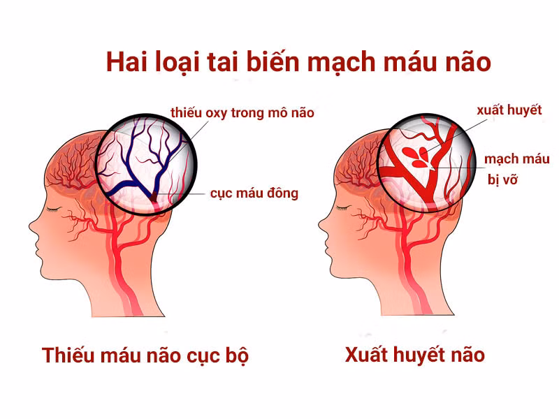 Hai loại tai biến mạch máu não thường gặp