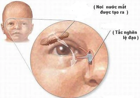 Hình ảnh lệ đạo bị tắc.