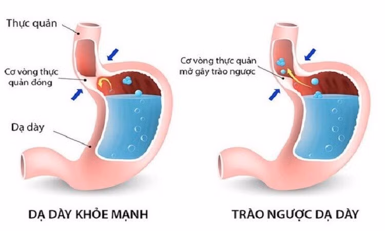 Cơ chế gây ra hiện tượng trào ngược dạ dày