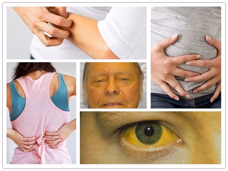 Triệu chứng khi men gan tăng cao