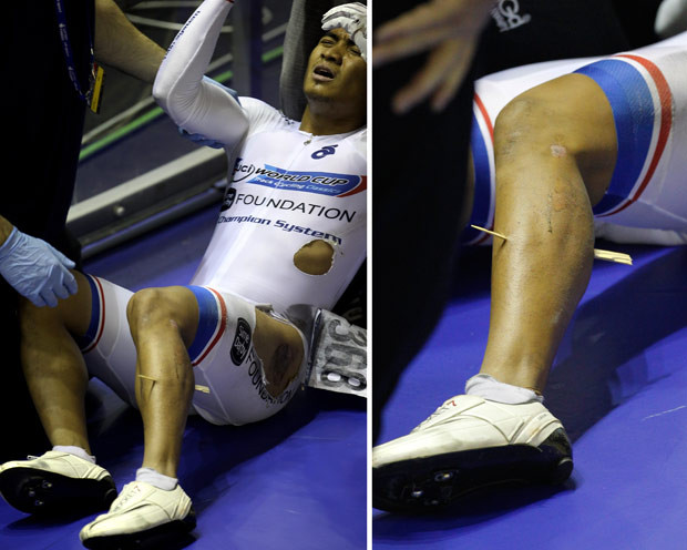 Azizulhansi Awang of Malaysia lies on the track after crashing out of the Men’s Keirin Final and sustaining a splinter through his leg during day two of the UCI Track Cycling World Cup Classic at Manchester Velodrome. He managed to remount his bike after the high-speed crash in and stagger across the line to claim a bronze medal. He was rushed to a local hospital but medics waited until Sunday to carry out the procedure to remove the 20-centimetre (7.8-inch) piece of wood from his left calf. 