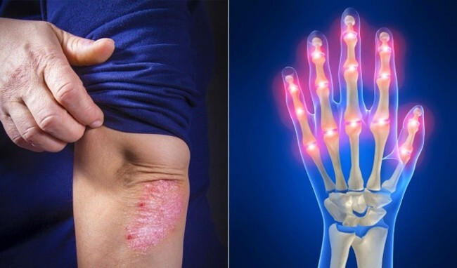 viêm khớp vảy nến