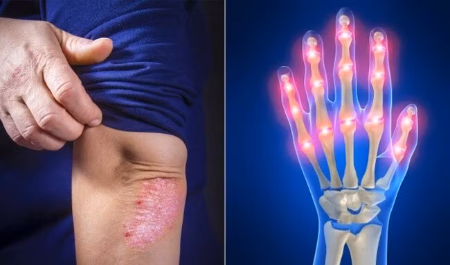 viêm khớp vảy nến