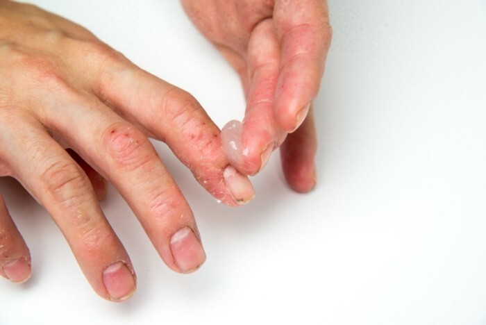 viêm khớp vảy nến