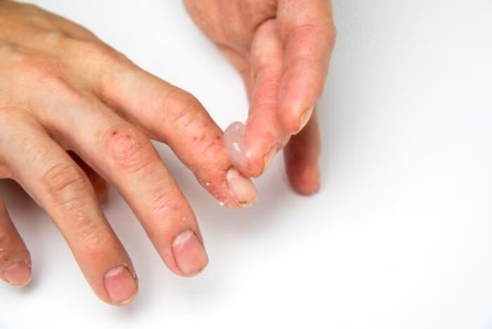 viêm khớp vảy nến