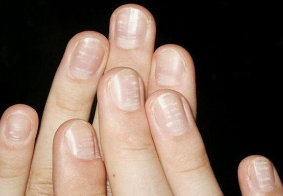 viêm khớp vảy nến