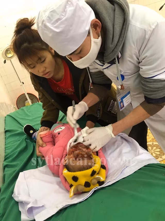 Mẹ dùng củi lửa và than sưởi ấm trong nhà, hai trẻ bị bỏng nặng