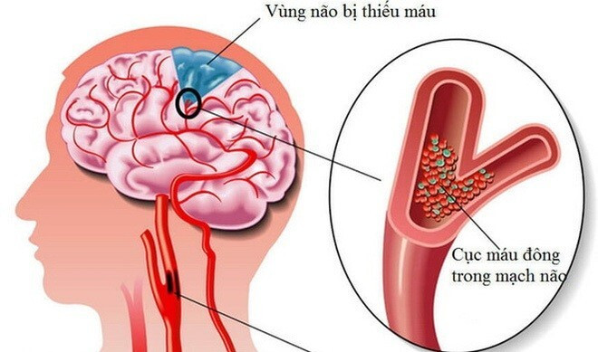 Thuốc Đông y thế hệ 2 phòng ngừa đột quỵ ở người trẻ tuổi ảnh 3 đột quỵ ở người trẻ tuổi