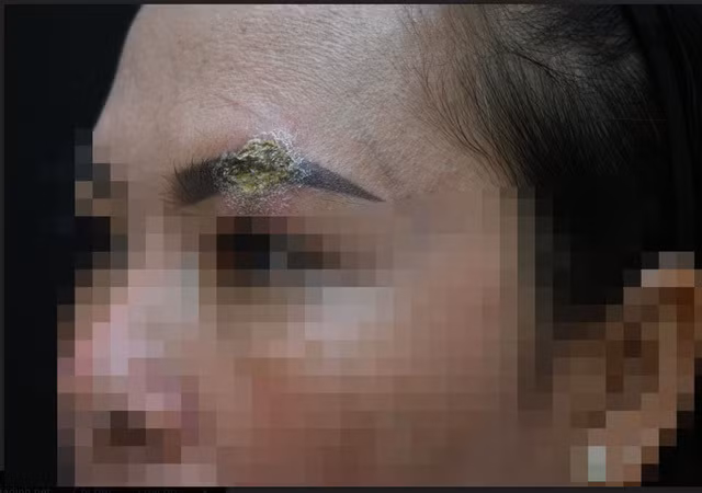 Môi của cô gái trẻ sưng phù, biến dạng sau khi làm đẹp tại thẩm mỹ viện