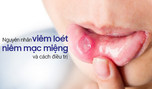 Viêm loét niêm mạc miệng