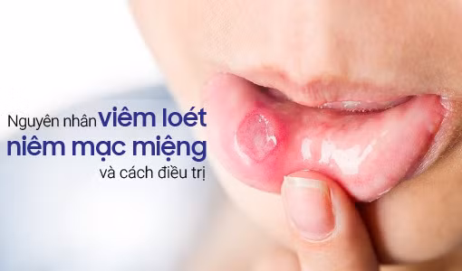 Viêm loét niêm mạc miệng