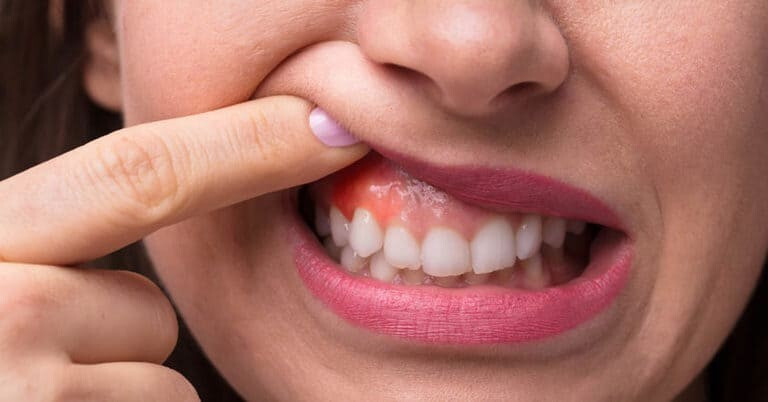 Đau răng kiêng ăn gì: Vấn đề quan trọng nhưng ít người để ý ảnh 2 đau răng kiêng ăn gì