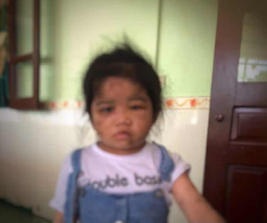 Phần mặt cháu T. bị bầm tím, sưng tấy.