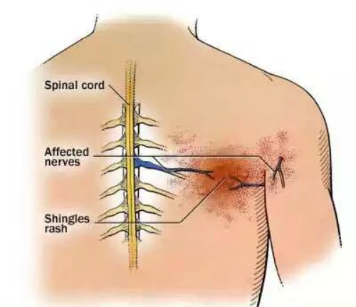 
Zona có thểgây biến chứng nghiêm trọng là đau dây thần kinh. 