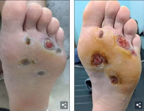 Nhiem vi khuan an thit vi thoi quen di tam khong mang dep - Anh 3