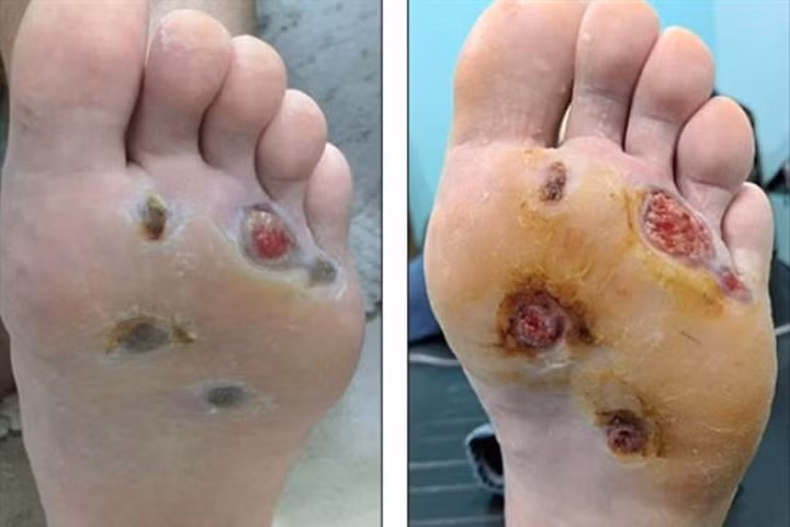 Nhiễm vi khuẩn ăn thịt vì thói quen đi tắm không mang dép