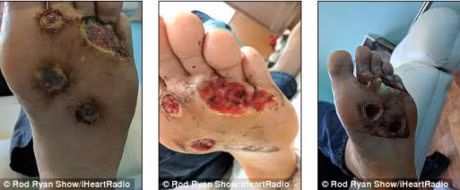 Nhiem vi khuan an thit vi thoi quen di tam khong mang dep - Anh 1