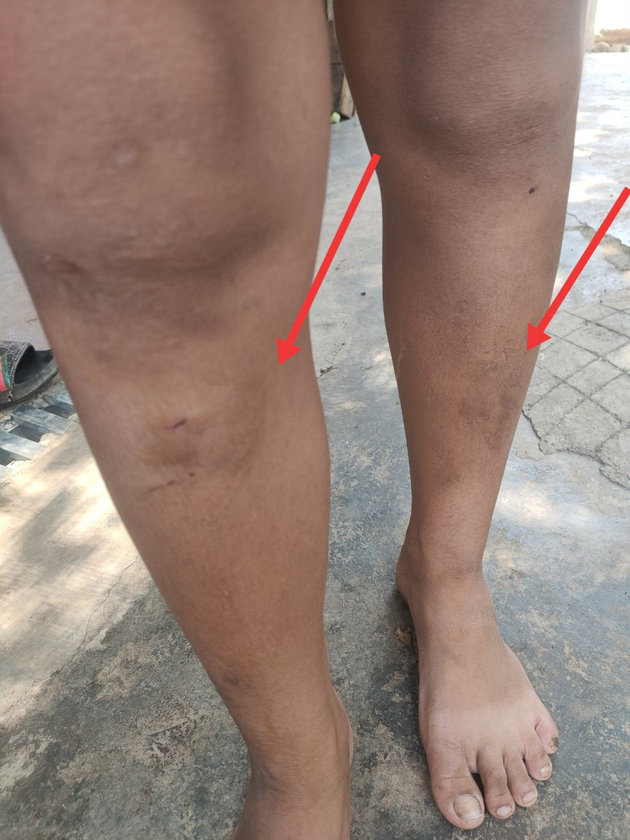 Một cháu nhỏ bị đánh gây thương tích ở chân. (Ảnh: TD) Một cháu nhỏ bị đánh gây thương tích ở chân. (Ảnh: TD)