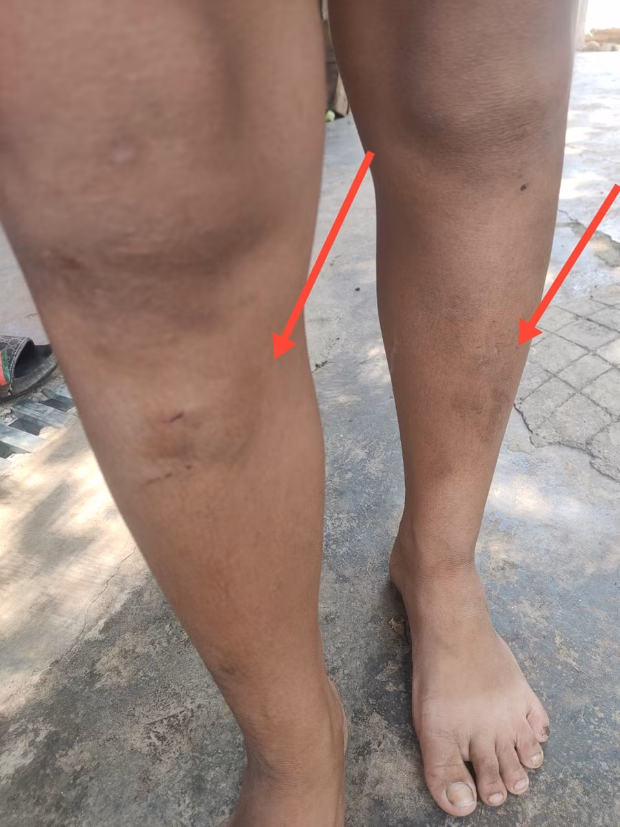 Một cháu nhỏ bị đánh gây thương tích ở chân. (Ảnh: TD)